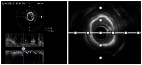 3、术中冠脉血管内超声(IVUS)评估.png